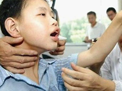 小儿癫痫发病如何救急